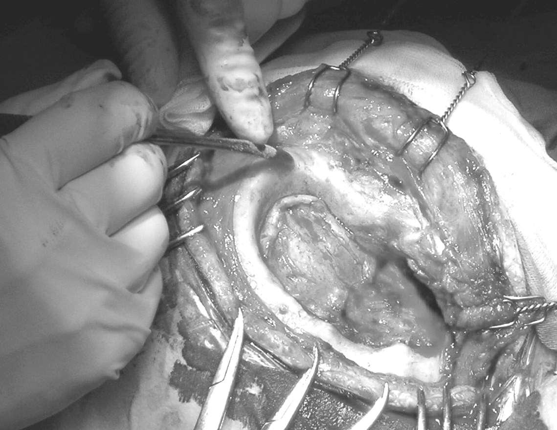 Cranioplastica new MAGAZINE