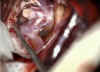 aneurisma_1.jpg (71991 byte)