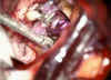 aneurisma_3.jpg (83711 byte)