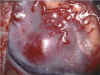 angioma.jpg (79767 byte)