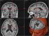 cavernoma parav.jpg (55668 byte)