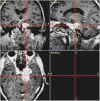 neurinoma-V.jpg (61500 byte)